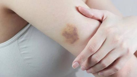 Дізнайтесь, чому з’являються синці без травм, які причини їх викликають та коли слід звернутись до лікаря. Повний гід по гематомах на тілі.