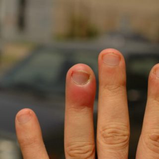 Дізнайтеся, як лікувати ущиб пальця: перша допомога, методи лікування, коли звертатися до лікаря, профілактика ускладнень.