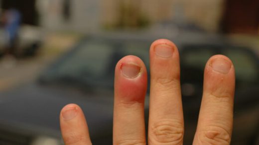 Дізнайтеся, як лікувати ущиб пальця: перша допомога, методи лікування, коли звертатися до лікаря, профілактика ускладнень.